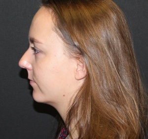 Chin implant and liposculpture of the neck