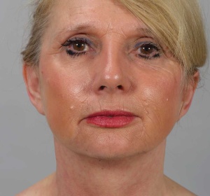  1218235 Facelift  Re post-op (1).jpg