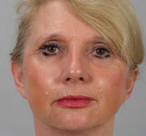 Volume restoration, correction of the jawline and improvement of the skin