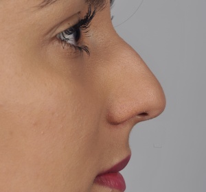 Lowering and narrowing the bony and cartilaginous bridge of the nose and refining the nasal tip