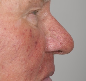 Rhinophyma van de neusvleugels