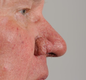 Rhinophyma van de neusvleugels