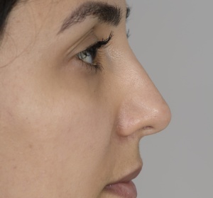 Lowering and narrowing the bony and cartilaginous bridge of the nose and refining the nasal tip