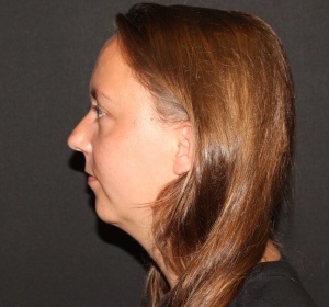 Chin implant and liposculpture of the neck