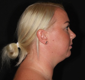 Chin implant and contouring of the neck by liposuction