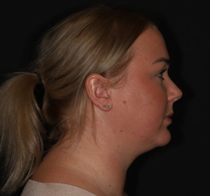 Chin implant and contouring of the neck by liposuction