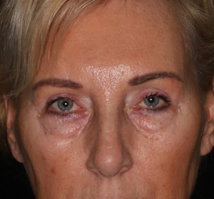 Reduction of the bags of the lower eyelid