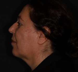 In some cases the contour of the neck can be improved by liposuction. This treatment is often combined with a facelift.