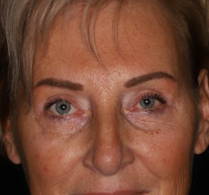 Reduction of the bags of the lower eyelid