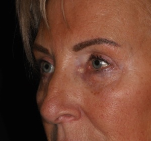 Reduction of the bags of the lower eyelid