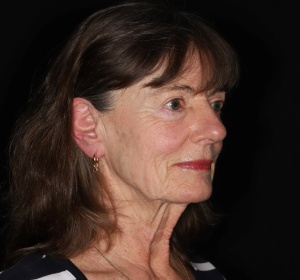 Improvement of the jawline and the neck
