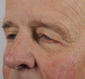 Limited or direct browlift of the left brow (with the scar in the upper outer margin)