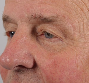 Limited or direct browlift of the left brow (with the scar in the upper outer margin)