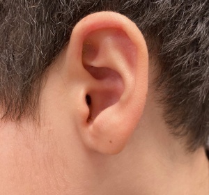 Correction of the edge of the auricle