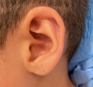 Correction of the edge of the auricle