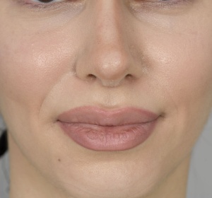 Reduction of the tip of the nose