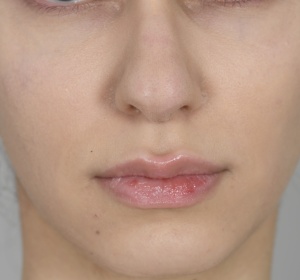 Reduction of the tip of the nose