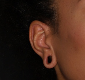 Reconstruction and closure of the earlobe (close-up)