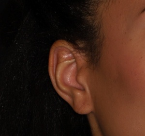 Reconstruction and closure of the earlobe (close-up)