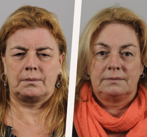 Een facelift in drie stappen