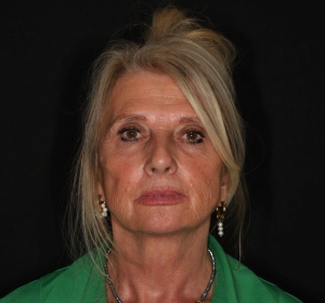 facelift + lipofilling gelaat (1).jpg