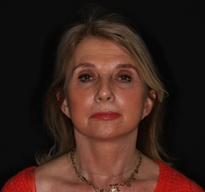 facelift + lipofilling gelaat (2).jpg