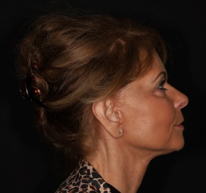 Facelift met litt. achter de haargrens (1).jpg