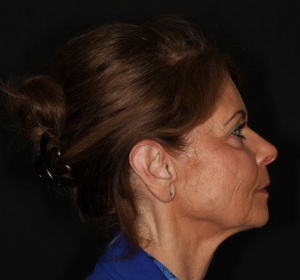 Facelift met litt. achter de haargrens (2).jpg