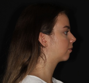 The ratio between the nose and the chin is more balanced after the chin implant