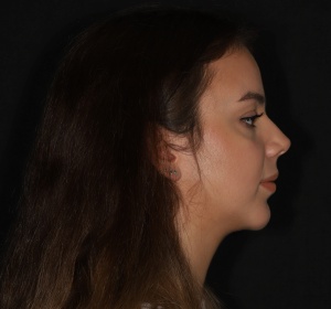 The ratio between the nose and the chin is more balanced after the chin implant