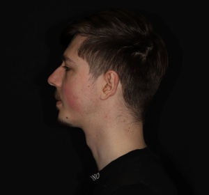 A stronger jawline after a chin implant