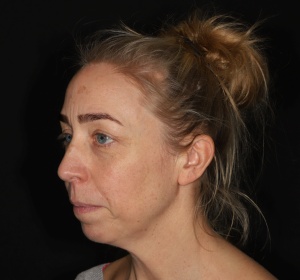 Chin augmentation and correction of the neck