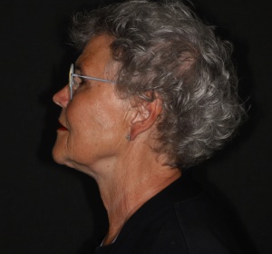 Locale halslift (2).jpg