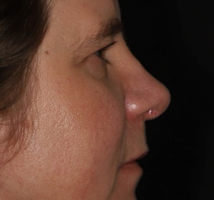 Decrease in projection of the nasal tip