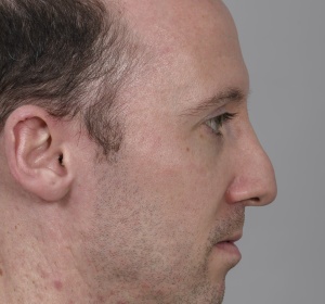 Secondary surgery and re-do of the nose