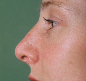 Reduction of a so-called tension nose and definition of the tip