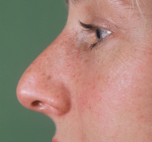 Reduction of a so-called tension nose and definition of the tip