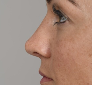 Upwards tilting of the tip of the nose