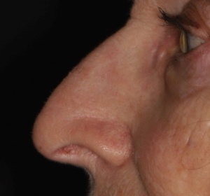 Neuscorrectie  77 j. close-up (2).jpg