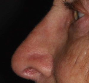 Neuscorrectie  77 j. close-up (3).jpg