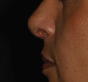 Upward rotation of the drooping nose tip