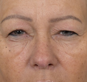 Shortening of the muscle that raises the upper eyelid (ptosis)