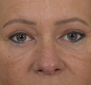 Shortening of the muscle that raises the upper eyelid (ptosis)