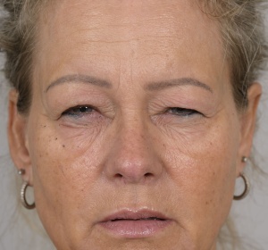 Shortening of the muscle that raises the upper eyelid (ptosis)