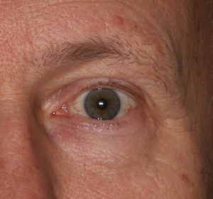 Rejuvenation of the eyelid by repositioning of the "lid-cheek junction"