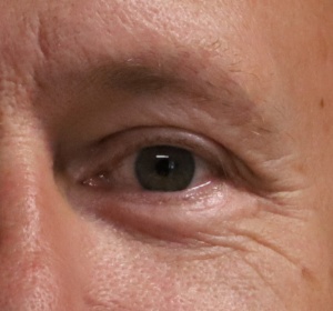 Rejuvenation of the eyelid by repositioning of the "lid-cheek junction"