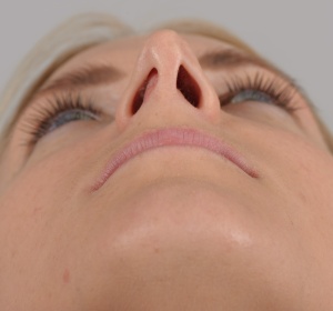 Decrease in projection of the nasal tip relaxes the nostrils