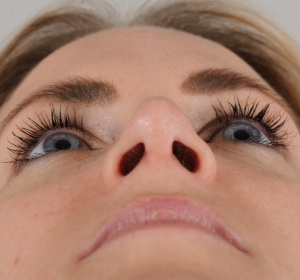 Decrease in projection of the nasal tip relaxes the nostrils