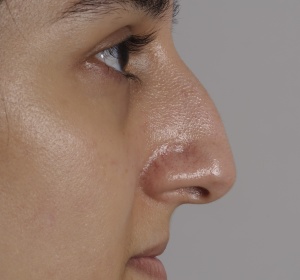 Lowering and narrowing the bridge of the nose and refining the nasal tip