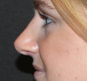 Reduction of the nose